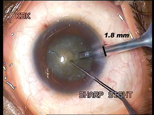MICS cataract surgery jalandhar punjab india