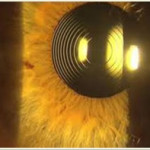 multifocal lense surgery jalandhar punjab