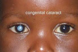 Pediatric_Ophthalmology_clip_image004