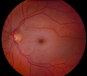 brvo retinal laser treatment jalandhar punjab