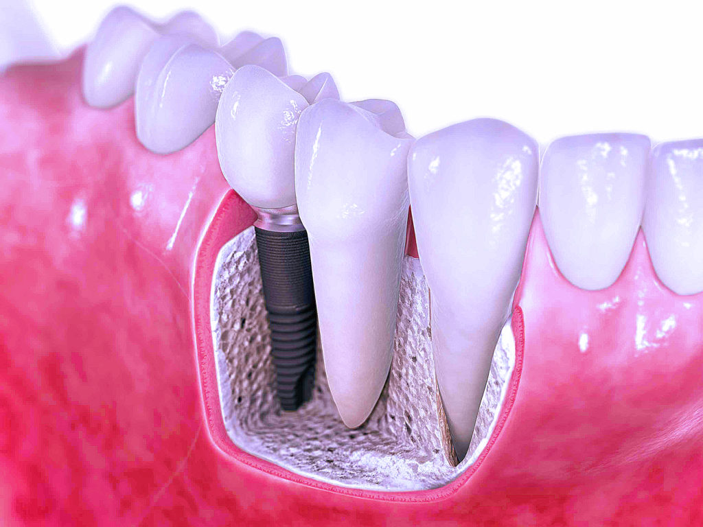 dental implant in just 3 days jalandhar punjab india