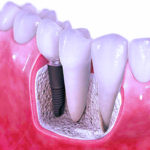 dental implant in just 3 days jalandhar punjab india