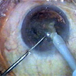 stichless phaco cataract surgery jalandhar punjab india