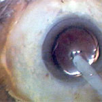 stichless phaco cataract surgery jalandhar punjab india