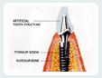 dental implant jalandhar punjab