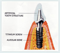 get fixed teeth dental implants in just 3 days jalandhar punjab india