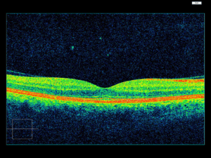 oct retina jalandhar punjab