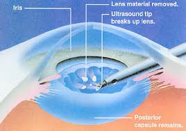stichless phacoemulsification cataract surgery jalandhar punjab india