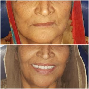 fixed teeth in just 3 days jalandhar punjab india