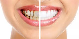 tooth whitening cost jalandhar punjab india