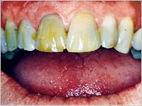 tooth whitening jalandhar punjab india