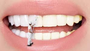 tooth bleaching cost jalandhar punjab