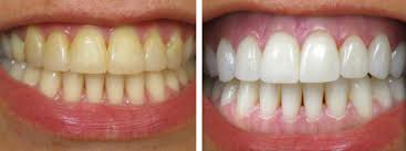 cost of dental bleaching in jalandhar punjab